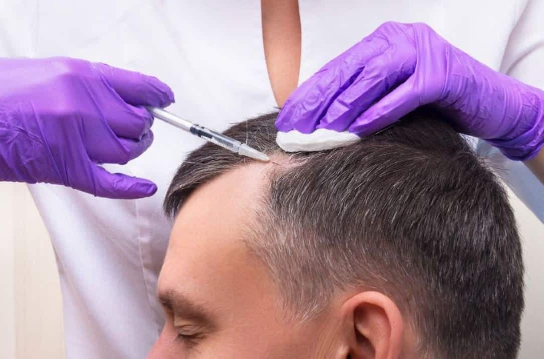 Haarausfall Nürnberg: Ursachen und moderne Behandlungsmöglichkeiten