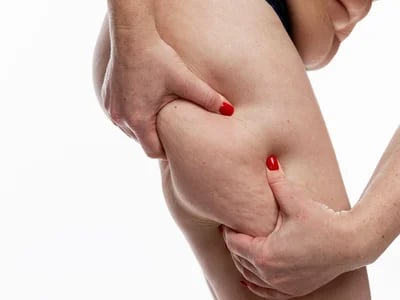 Anzeichen Lipödem: Warum eine frühe Diagnose Lebensqualität rettet